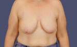 Breast Lift w/ Augmentation 10 Before